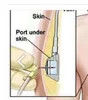 Disposable Medical Huber Needle with Tube for Chemotherapy, Antibiotics, and Tpn IV Port